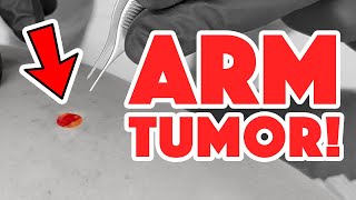 ARM TUMOR [upl. by Halac]