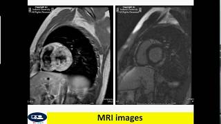 Myocarditis in MRI [upl. by Giraldo]