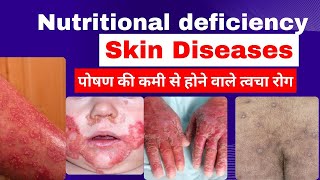 Skin disease due to nutritional deficiency  nutritional deficiency skin disorders  skin problem [upl. by Sussman]