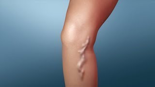 Natural Remedy GET RID OF VARICOSE VEINS  EFFECTIVE TREATMENTS 100 WORKS [upl. by Siddra699]