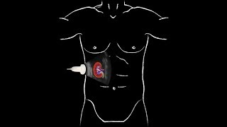 POCUS  Basic Renal Ultrasound [upl. by Tena]