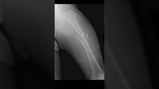 Acute comminuted mid third femoral fracture xraylife [upl. by Hayidah]