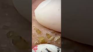 Skincare  Blackheads Removal 132 skincare skincare blackheads blackheads [upl. by Shepley87]