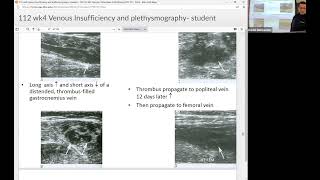 Venous Plethysmography [upl. by Nosa535]