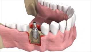 How DENTAL IMPLANTS are inserted  3D simulation [upl. by Ursula]