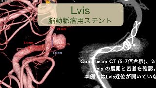 Lvis stent 留置の基本 [upl. by Eednahs579]