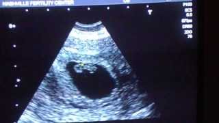 7 Week and 1 Day Ultrasound [upl. by Harness291]