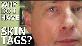 What Are Skin Tags And How Do I Stop Them From Forming Common Sense Medicine [upl. by Alliuqal]