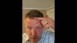 My Hair Transplant Experience  Day 2  The Toronto Hair Transplant Clinic [upl. by Raimondo]