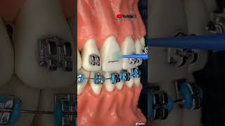 TUTORIAL “INSTALACIÓN de BRACKETS metálicos” [upl. by Julie170]