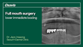 Clinical Case Full mouth surgery lower immediate loading [upl. by Oigroeg]