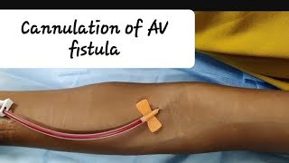 How to prick AV fistula First time Cannulation of AV fistula and Assessment [upl. by Mavis]