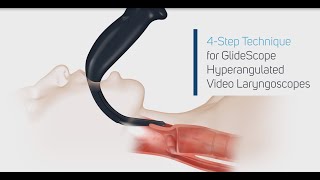 How to Intubate Using a GlideScope® Video Laryngoscope in 4 Steps [upl. by Friedland]