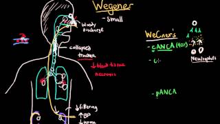 Wegener and Microscopic Polyangiitis [upl. by Innis]