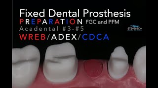 Fixed Dental Prosthesis Preparation  35 Acadental  WREBADEXCDCA [upl. by Natsirc99]