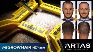 Best FUE  Nicks ARTAS Hair Transplant [upl. by Ennairda17]