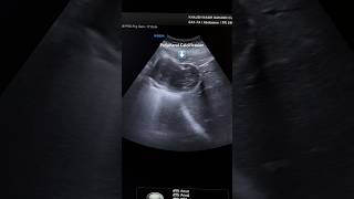 Hepatic Hydatid Cyst Ultrasound  Liver Sonography ardms radiology abdomen cyst sonographer [upl. by Acinomal880]