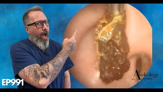 HOW TO SAFELY REMOVE A HUGE EAR WAX PLUG Earwax removal  EP991 [upl. by Casaleggio]