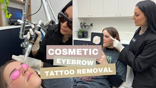 Cosmetic Eyebrow Tattoo Removal with LaserTat [upl. by Eirruc575]