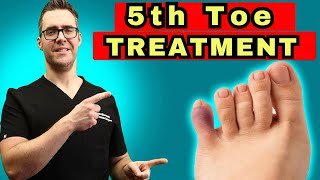 What To Do For A Broken Pinky Toe How To Tape amp Little Toe Treatment [upl. by Eillehs]