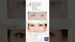 Best 5 Double Eyelid Surgery at ID Hospital [upl. by Hyacinthie]