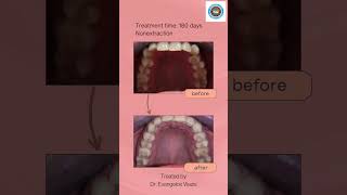 Orthodontics Fastbraces treatment time 180 days nonextraction treated by Dr Evangelos Viazis 26 [upl. by Spindell]