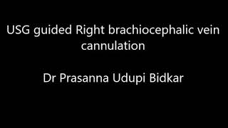 Bidkar approach to subclavian vein cannulation using USG supraclavicular approach [upl. by Berke]