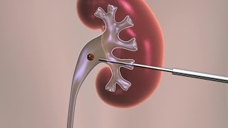 Percutaneous Nephrolithotomy [upl. by Ohce]