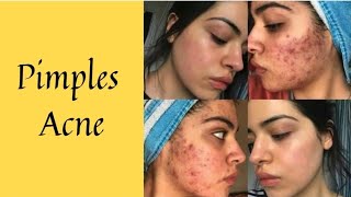 Now stop acne pimple and other skin problems  Forever aloe propolis cream  aloe Vera gel [upl. by Phineas]