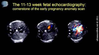 Fetal echocardiography at 1113 weeks of pregnancy [upl. by Loram]