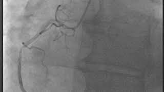 CORONARY Angiogram 2 [upl. by Blackburn52]