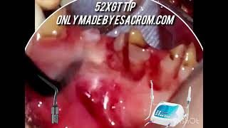 Embedded 305 premolar how to extract it easily in 10 seconds [upl. by Hyatt990]