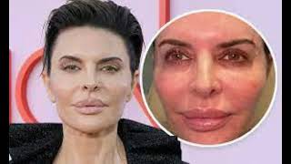 Lisa Rinnas Cosmetic Procedures Learning from Mistakes Lisa Rinna a familiar face from the R [upl. by Mcclees48]