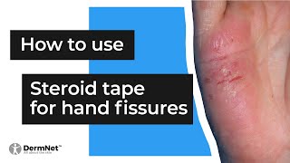 How to use steroid tape for hand fissures [upl. by Aicnarf]