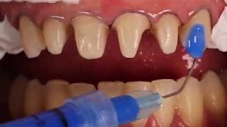 Adhesive cementation of ceramic veneers [upl. by Laius973]