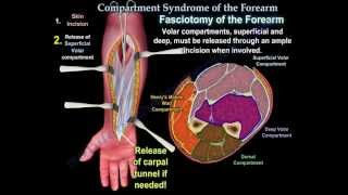 Compartment Syndrome Of The Forearm  Everything You Need To Know  Dr Nabil Ebraheim [upl. by Bal813]