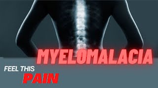 Feel This Pain S3E3 Myelomalacia [upl. by Capone]