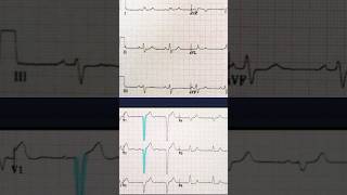 Left bundle branch block LBBB ECG Findings [upl. by Matthieu]