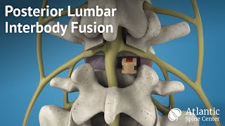 Posterior Lumbar Interbody Fusion PLIF [upl. by Engis354]