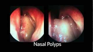 AAOHNSF The ENT Exam Episode 4 The Nasopharynx and Larynx Exam [upl. by Ennayr761]