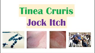 Jock Itch Tinea Cruris  Causes Risk Factors Signs amp Symptoms Diagnosis and Treatment [upl. by Egidio948]