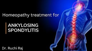 HOMEOPATHY TREATMENT FOR ANKYLOSING SPONDYLITIS [upl. by Akkim]