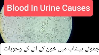 Causes of Blood in Urine  Hematuria  Calcium Oxalate in Urine [upl. by Janerich]