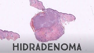 Hidradenoma Acrospiroma pathology dermatology dermatopathology skin adnexal sweat gland tumor [upl. by Llehsam]