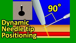 Ultrasound guided dynamic needle tip positioning in peripheral vein and artery cannulation [upl. by Magulac762]