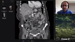 Isolation tutorial Abdominal CT with Vikas Shah [upl. by Ettenwahs90]