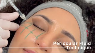 Periocular Fluid Technique injection protocol by Dr Siquier amp Dr Taskesen [upl. by Sweet280]