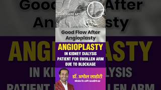 Central Venous Angioplasty Swelling of Dialysis Arm in Kidney Disease Patient healthshorts ytshort [upl. by Tterraj392]