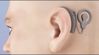 Cochlear Implant Animation [upl. by Kenton]