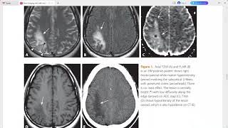 BRAIN IMAGING WITH MRI AND CT [upl. by Forelli34]